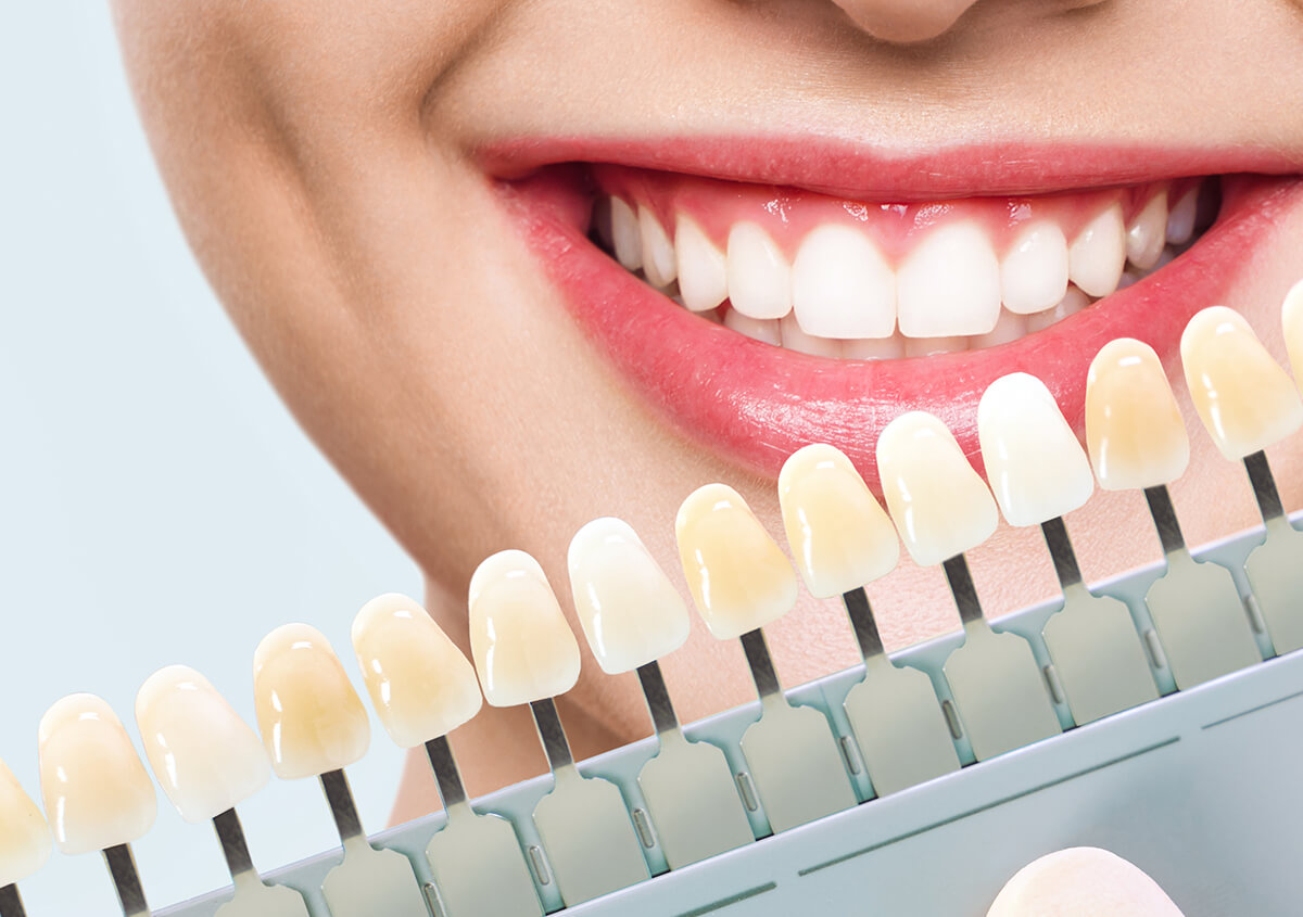 Boost your smile appeal with natural-looking Porcelain Dental Veneers