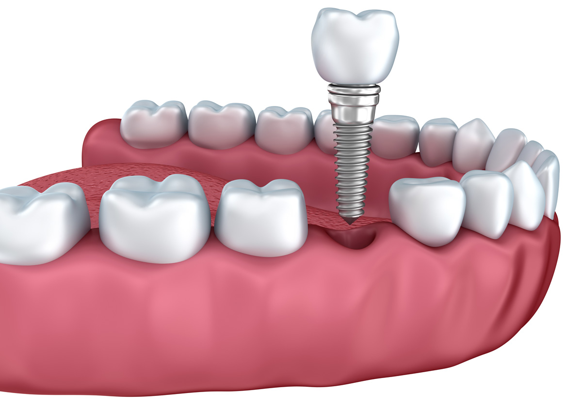 Get healthy smile With Dental Implant Dentist Near Me In Beverly Hills, CA