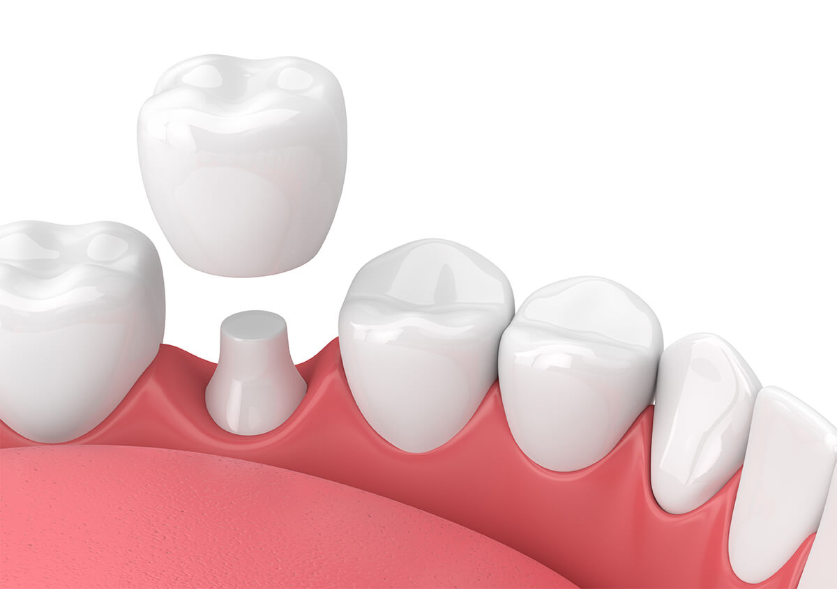 Cosmetic Teeth Crowns in Beverly Hills CA Area