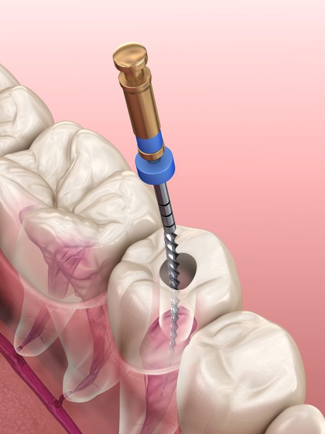 Everything you needed to know about endodontics