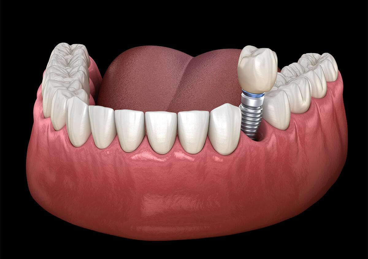 Dentist That Do Implants in Beverly Hills CA Area