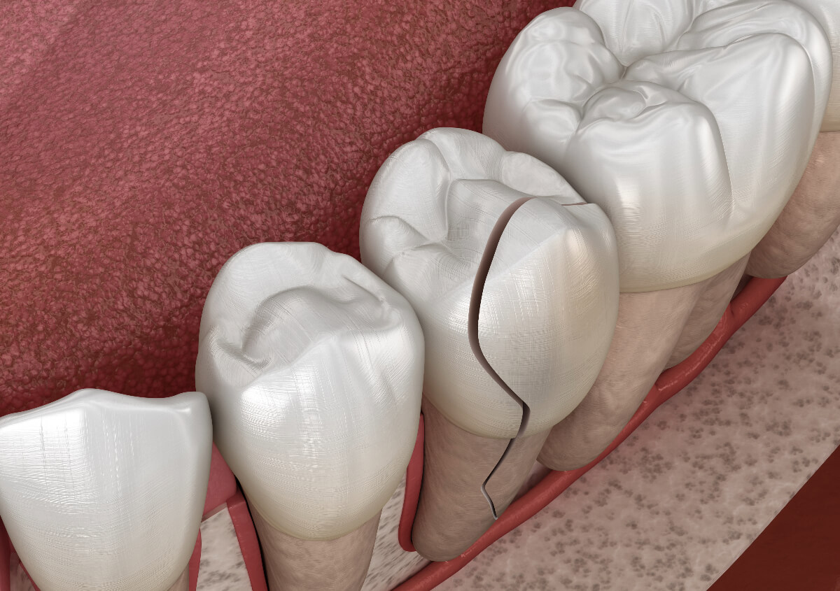 Cracked Tooth Repair Specialists in Beverly Hills area