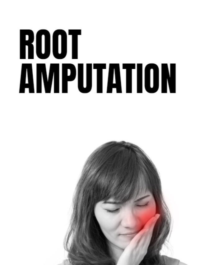 Root Amputation